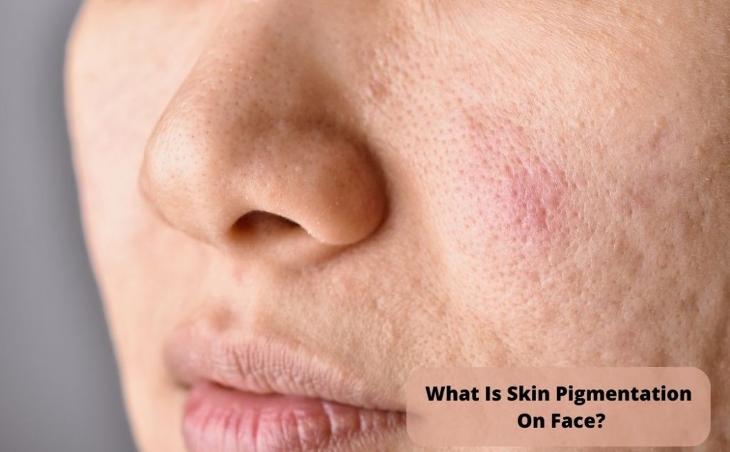 What Is Skin Pigmentation On Face