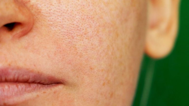 What Is Skin Pigmentation On Face? (How to Treat)