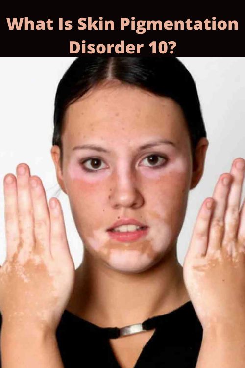 what is skin pigmentation disorder 10