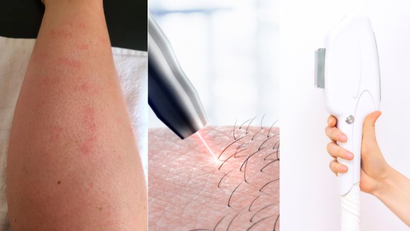 laser hair removal cause acne