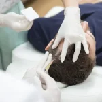 Can A Dermatologist Treat Hair Loss