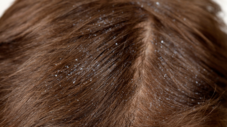 Does Dandruff Cause Hair Loss?
